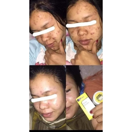 Serum Acne Nrl