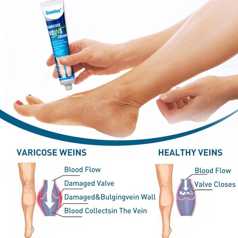 Salep Varises Cream Varicose Veins Obat Varises Kemaluan Bengkak Benjolan Buah Zakar Nyeri Testis Varicose Veins Cream 20Gr