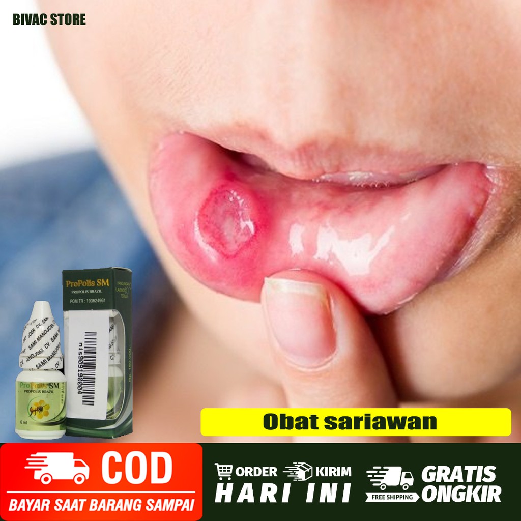 obat sariawan - sariawan di bibir - gusi sariawan - sariawan di lidah - sariawan