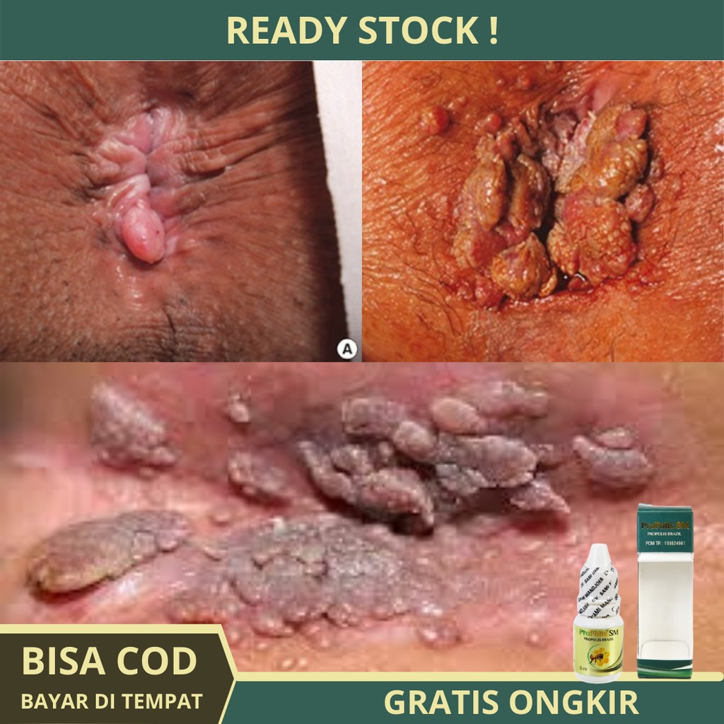 Obat Tetes Rontokan Kutil Di Anus Pria Dan Wanita, Anus Bengkak Dan Sakit, Kutil di anus, Kutil Di l