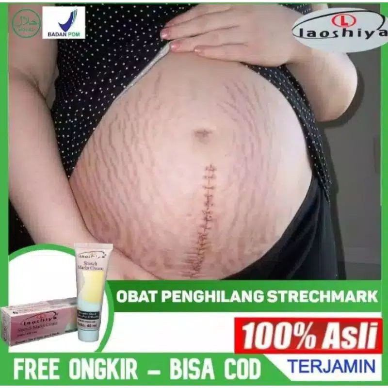 penghilang strechmark penghilang bekas luka penghilang keloid penghilangselulit