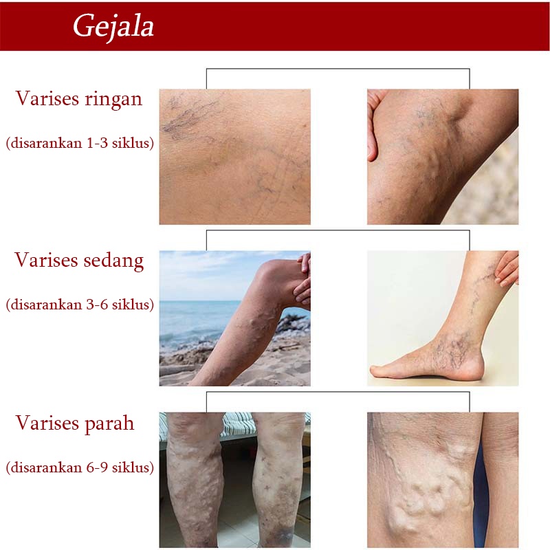 Terlaris !!! Varicose Veins Obat Varises Varikokel Bengkak Benjolan Buah Zakar Nyeri Testis Paling Ampuh Varicose Veins Treatment Cream/Obat Krim Varises Parises Tanpa Operasi