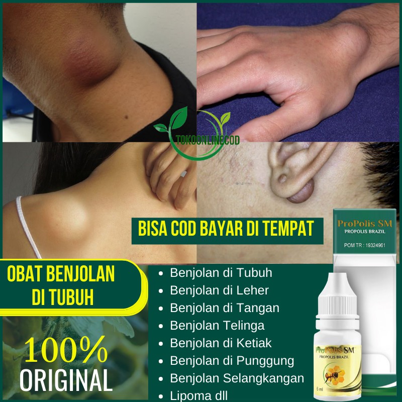 Obat Oles Penghilang Benjolan di Tubuh Leher Tangan Ketiak Pungung Kepala & Selangkangan 100% ORI