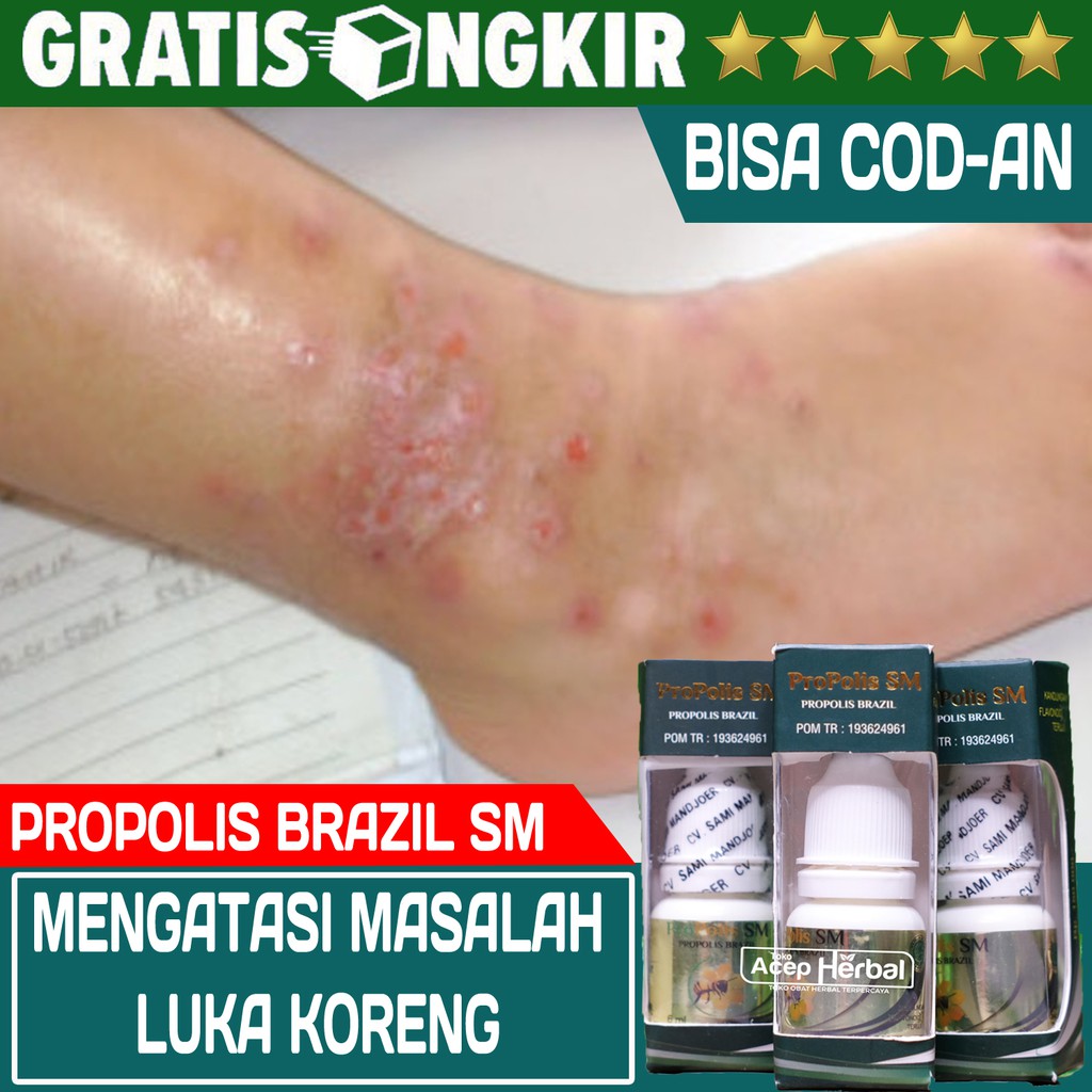 Obat Luka Koreng, Koreng Bernanah, Koreng Di Telinga, Koreng Di Kaki, Luka Basah - Propolis SM