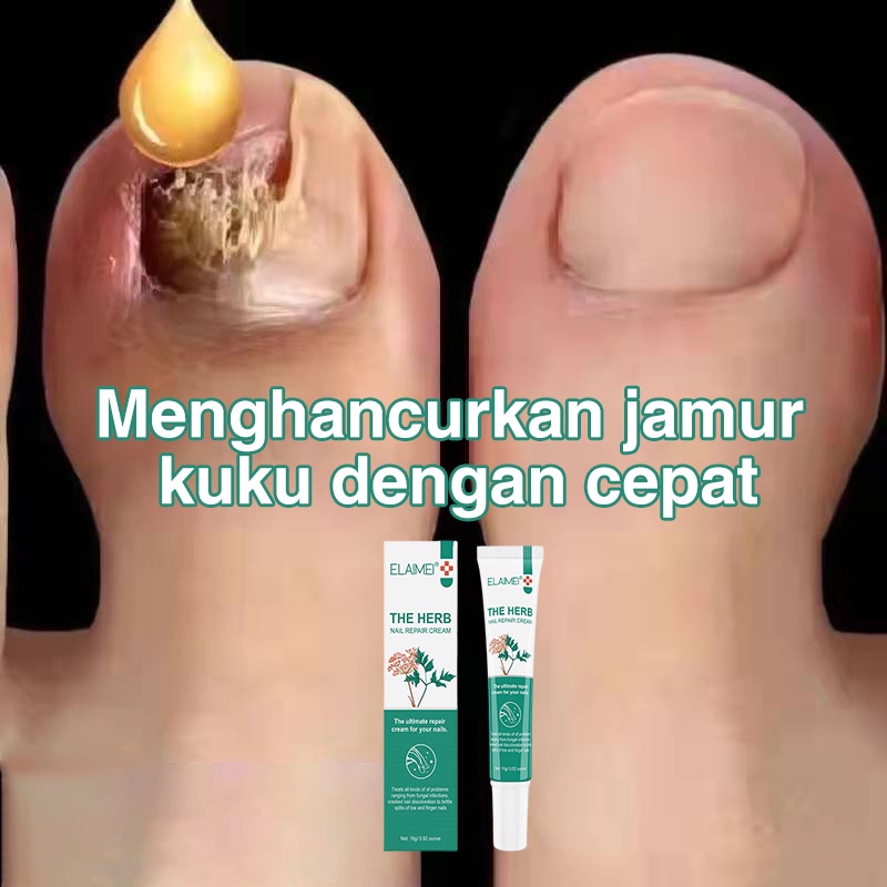 [100% Asli ] obat jamur kuku Perawatan Jamur Kuku Paronychia Perawatan Lumut Kuku Pemutih Kuku Penghilang Jamur Kuku Gel Anti Infeksi Obat Kuku Rusak Busuk Berjamur Infeksi kuku Jempol Obat Cantengan Jempol Kaki Obat Kuku Bengkak Obat Kuku Kaki