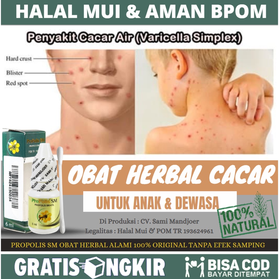 Salep Cacar, Obat Oles Cacar Air, Obat Alami Cacar Api, Cacar Monyet Untuk Anak & Dewasa, Obat Cacar