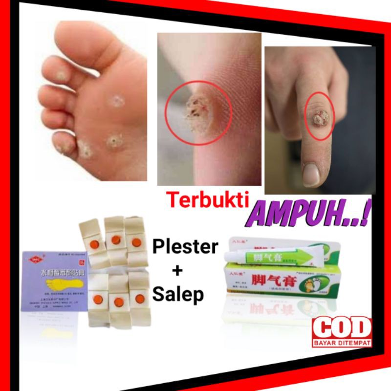 Jual Obat Plester Penghilang Mata Ikan Kapalan Kaki Pecah Pecah Tw20 Indonesia Shopee Indonesia