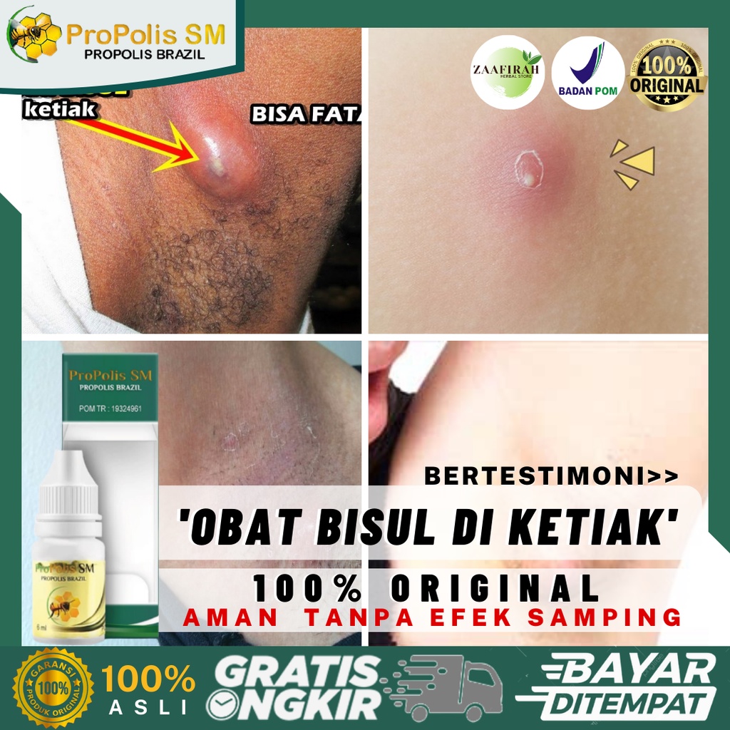 Obat Bisul Di Ketiak - Bisul Bernanah - Benjolan Bernanah Di Ketiak - Pengempis Bisul Di Ketiak - Pe