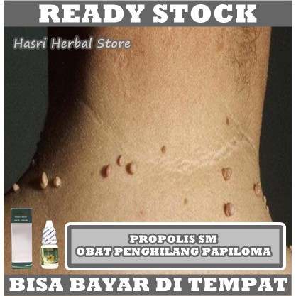 Obat Kutil, Obat Kutil Di Leher, Obat Kutil Di Wajah, Obat Herbal Kutil, Obat Penghilang Kutil, Obat Perontok Kutil, Obat Herbal Perontok Kutil, Obat Herbal Perontok Kutil di Tubuh, Obat Alami Atasi Penyebaran Kutil - Obat Herbal Mata Ikan Obat Mata Ikan