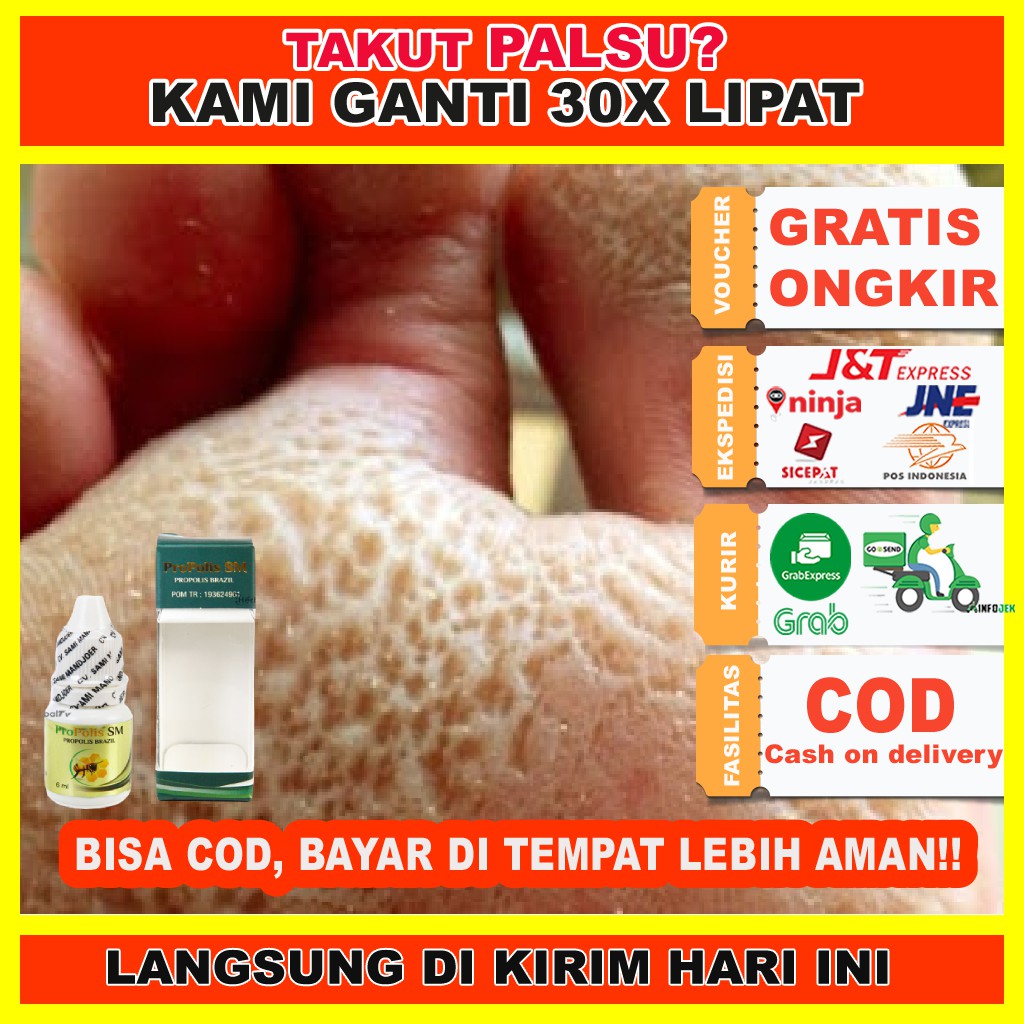 Obat Telapak Kaki Bolong Bolong/ Obat Kaki Rayapan/ Obat Penghilang Kaki Rayapan/ PROPOLIS BRAZIL SM