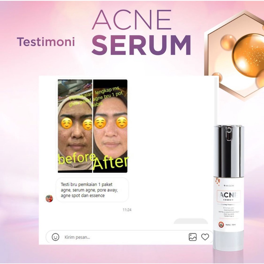 MS GLOW SERUM ACNE, SERUM LUMINOUS, SERUM WHITENING, SERUM PEELING ORIGINAL 100%