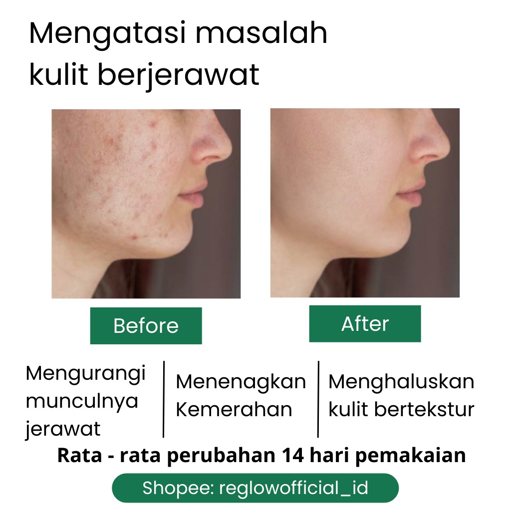 PAKET ACNE Reglow dr Shindy Skincare Untuk Kulit Berminyak Berjerawat Dan Bruntusan Sensitif Penghilang Bopeng Bekas Jerawat Komedo Noda Hitam Pori Besar Fungal Acne Pencerah Kulit Kusam Scincare Re glow Ori Rglow Paket Murah Reg glow Official Store