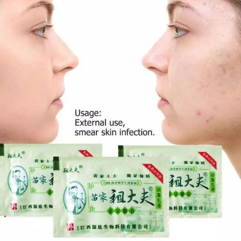 Salep antibakteri krim psoriasis eksim pengobatan mengupas herbal krim pembersih wajah perawatan kul