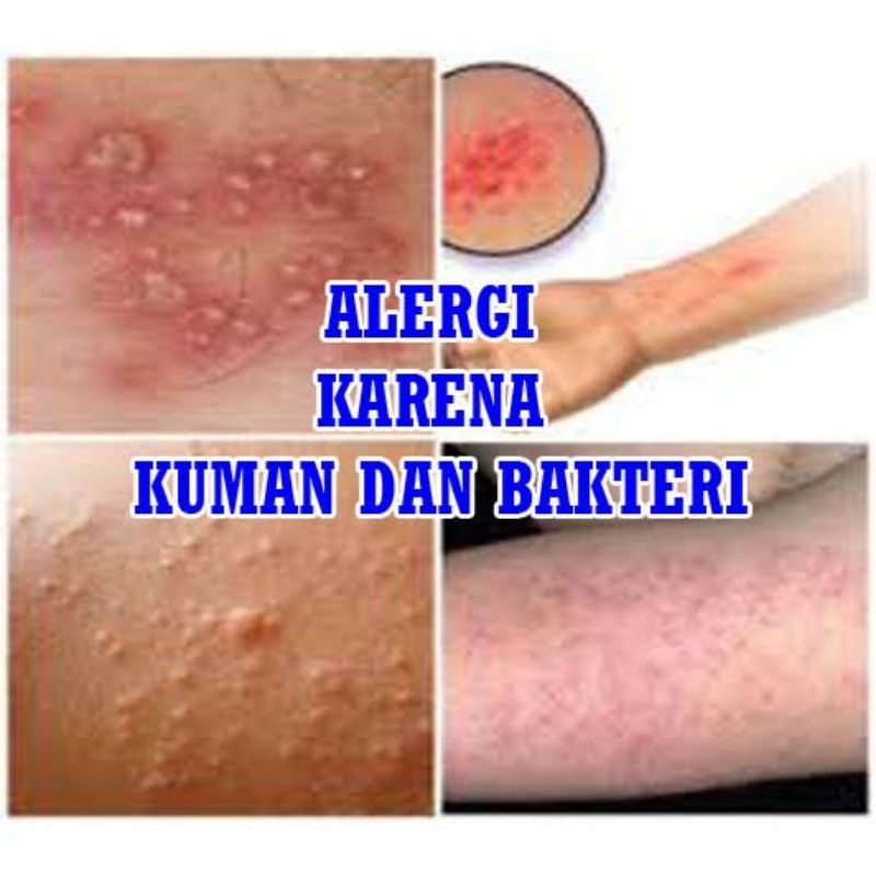 SALEB BL ORIGINAL ASLI 100% / OBAT GATAL SELANGKANGAN PALING AMPUH / SALEP GATEL SELANGKANGAN PANU KADAS KUTU AIR-6