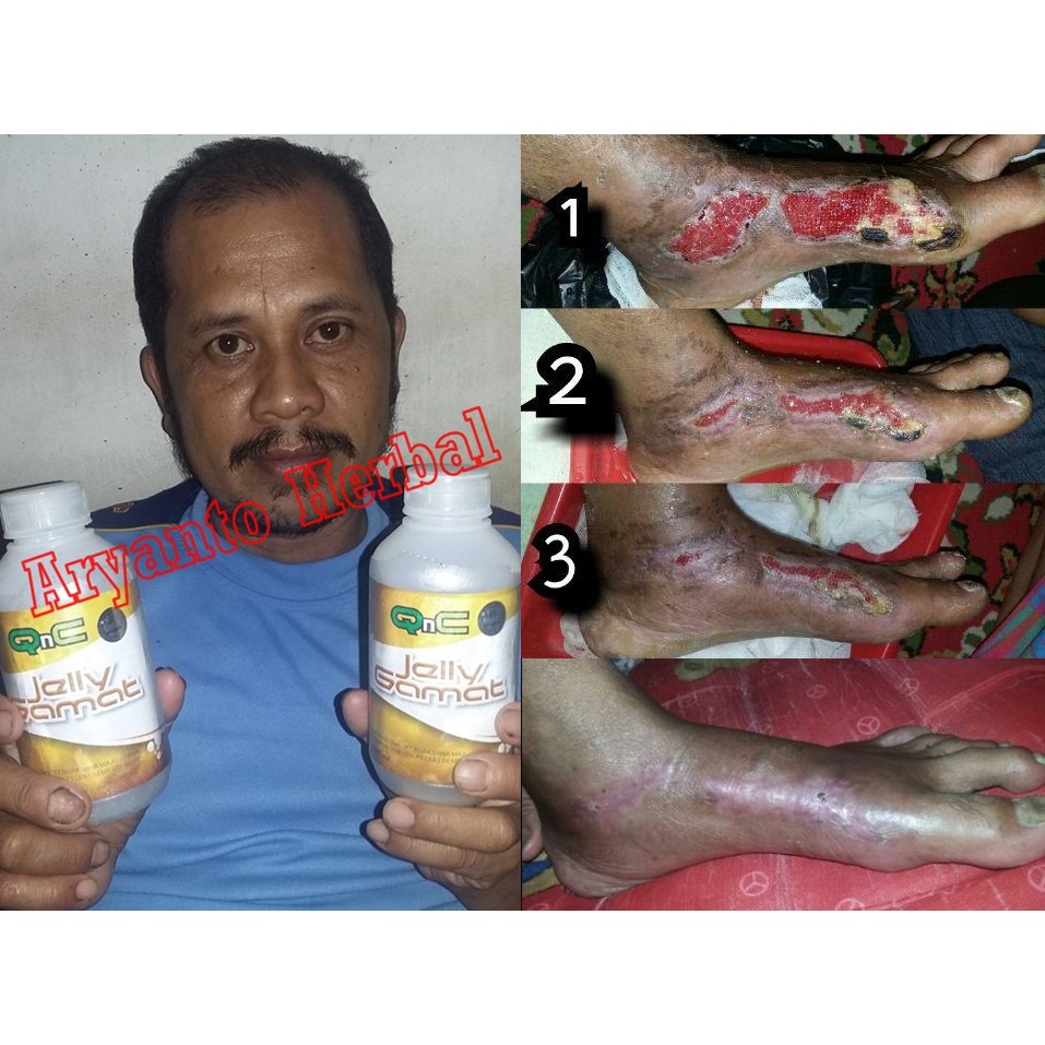 Vitamin GAMAT jelly gamat merek QNC 2x lipat ekstrak teripang lebih banyak adherbal-6