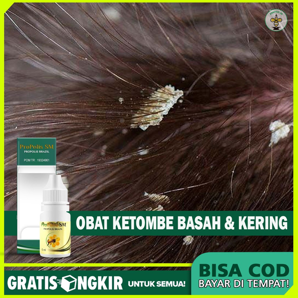 OBAT KETOMBE BERKERAK - OBAT KETOMBE BASAH / KERING - OBAT KETOMBE BERSISIK PARAH - PROPOLIS SM ORI