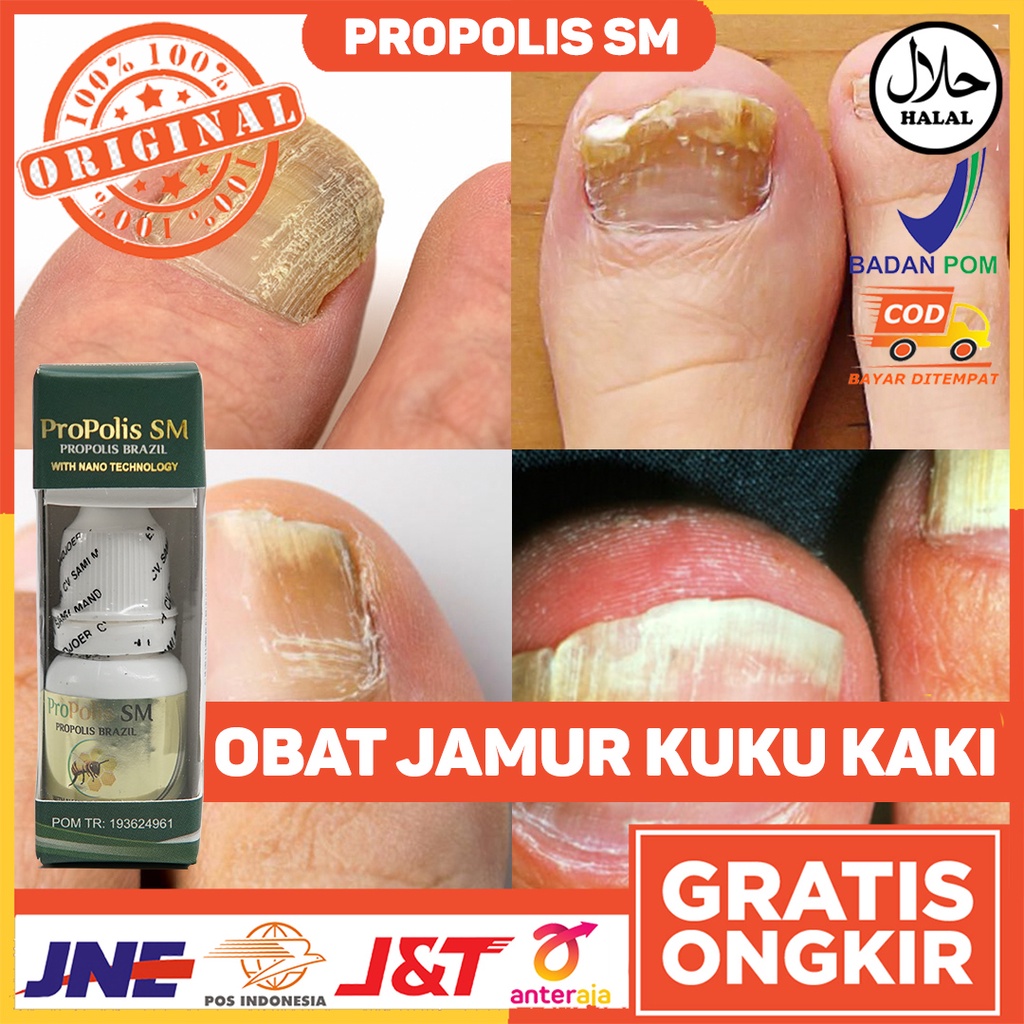 Obat Jamur Kuku Kaki - Obat Jamur Kuku Tangan - Obat Jamur Kuku - Obat Kuku Mati - Obat Infeksi Pada