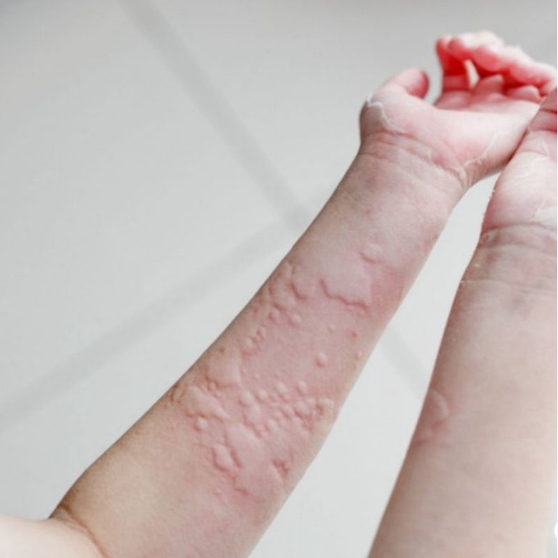 Obat Biduran Gatal Gatal Kulit Alergi Dingin Gatel Ampuh Bintik Merah Bentol Kulit Panu Kurap Kudis Kadas Eksim Obat Gatal Ampuh Jamur Kulit Herbal Naturindo Hepatifit BPOM halal Ampuh gatel gatel gatal Biduran Akut Hepatifit Naturindo Bpom-BIDURAN