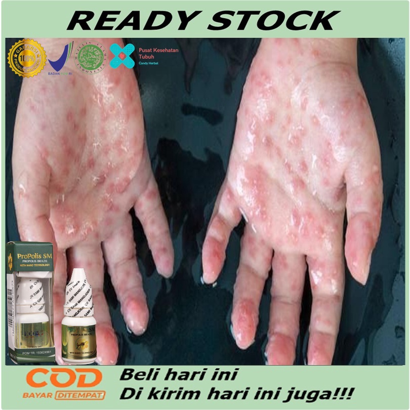 Jual Obat Gatal Berair Di Jari Tangan Dan Kaki Obat Bintik Bening Berair Gatal Bernanah 8913