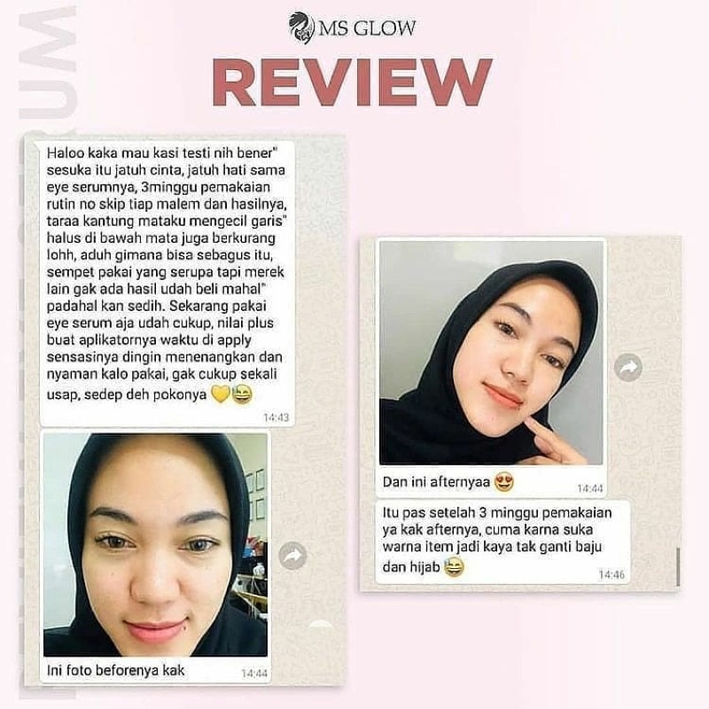 EYE TREATMENT MS GLOW