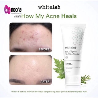 WHITELAB ACNE CARE FACIAL WASH