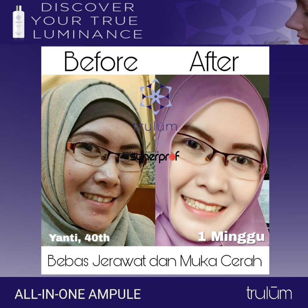 [717‘ Serum Untuk Penghilang Bekas Jerawat,..Krim Untuk Memutihkan Wajah Cowok Dalam 1 Minggu