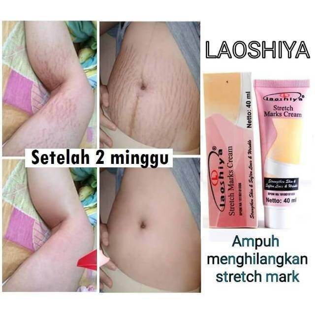 LAOSHIYA Stretchmark Cream / Penghilang Stretch Mark / Selulit Ampuh Original