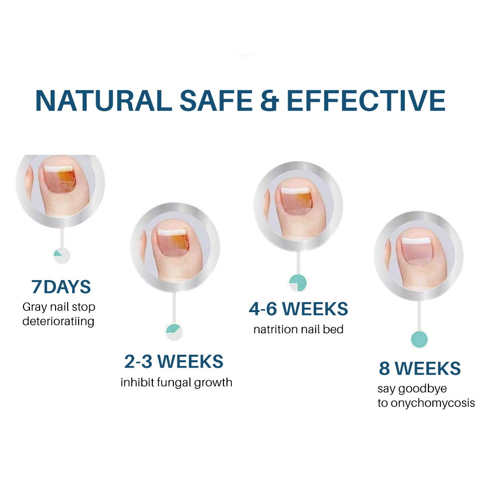 Perbaikan Kuku Berjamur Rusak Ringan dan tidak mengiritasi