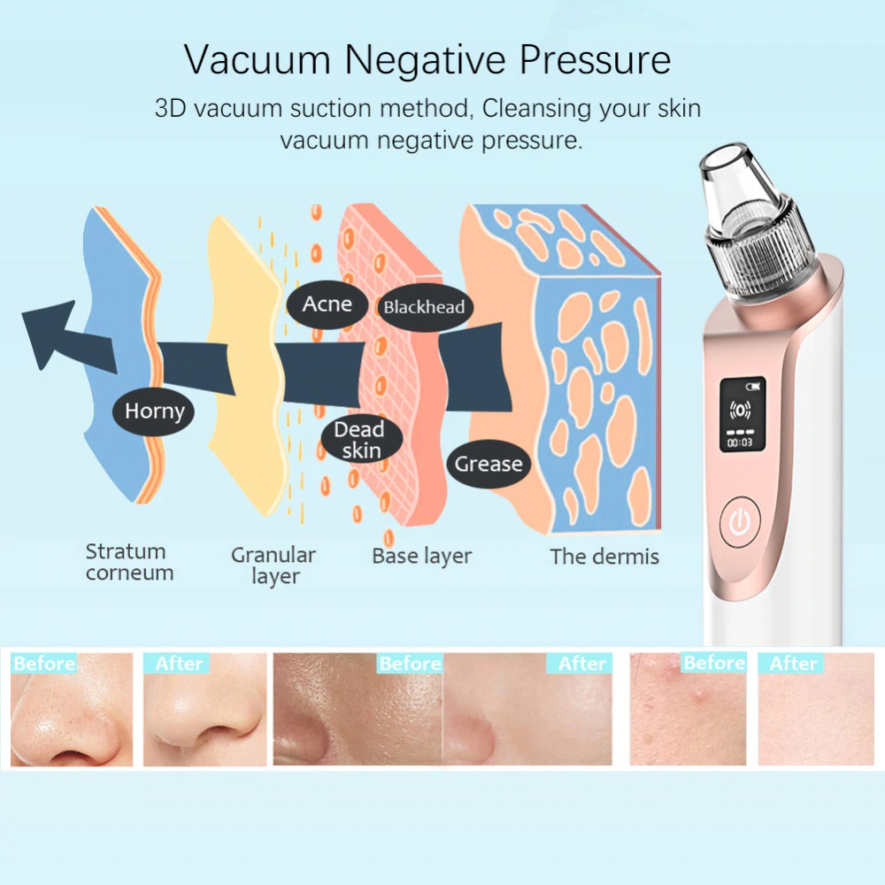 Penghisap Komedo Vacuum Suction Skin Face Care Blackhead Pore Cleaner - ALHTY03-01R