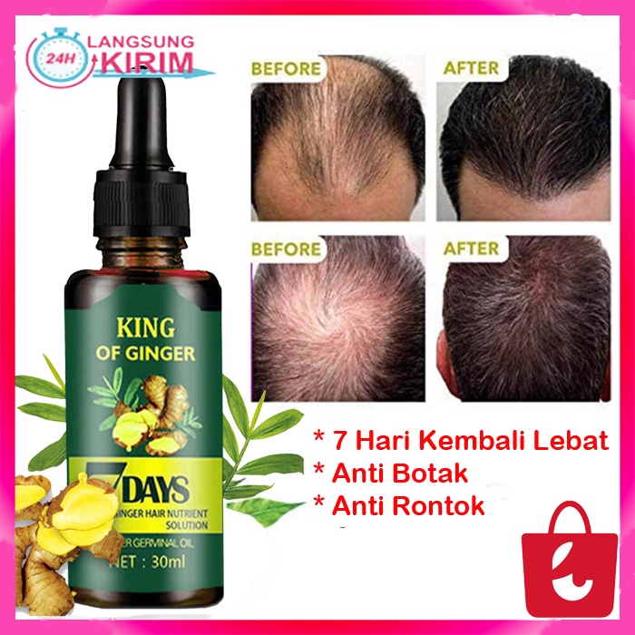 [7 Hari Rambut Tebal] 7Days Hair Clothes Of Skin V Minyak Penumbuh Rambut Rontok Anti Botak