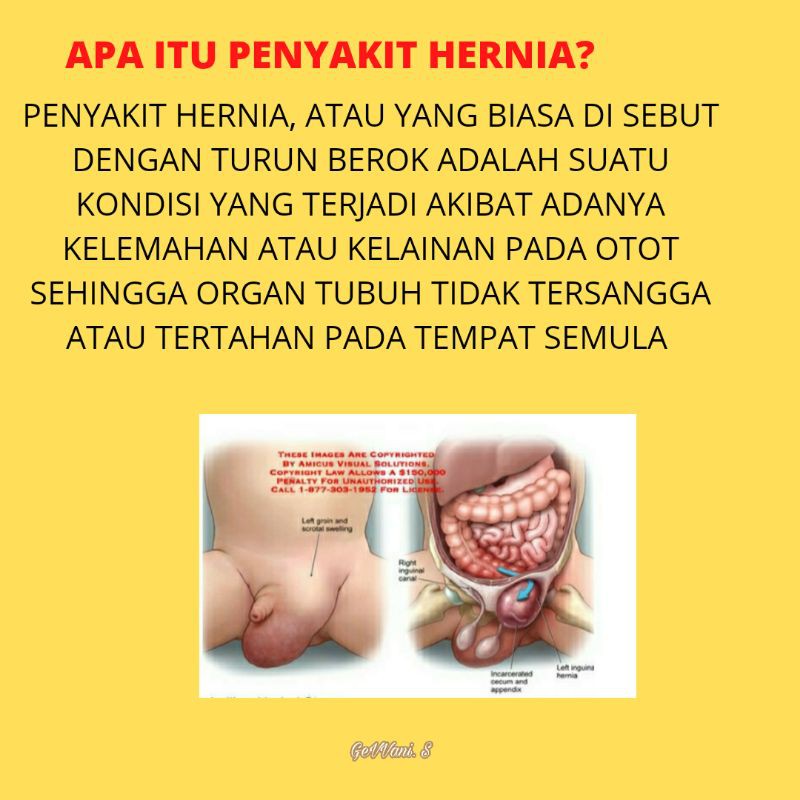 Celana Hernia Celana Hernia Anak Celana Terapi Hernia Aman Nyaman Murah Berkualitas