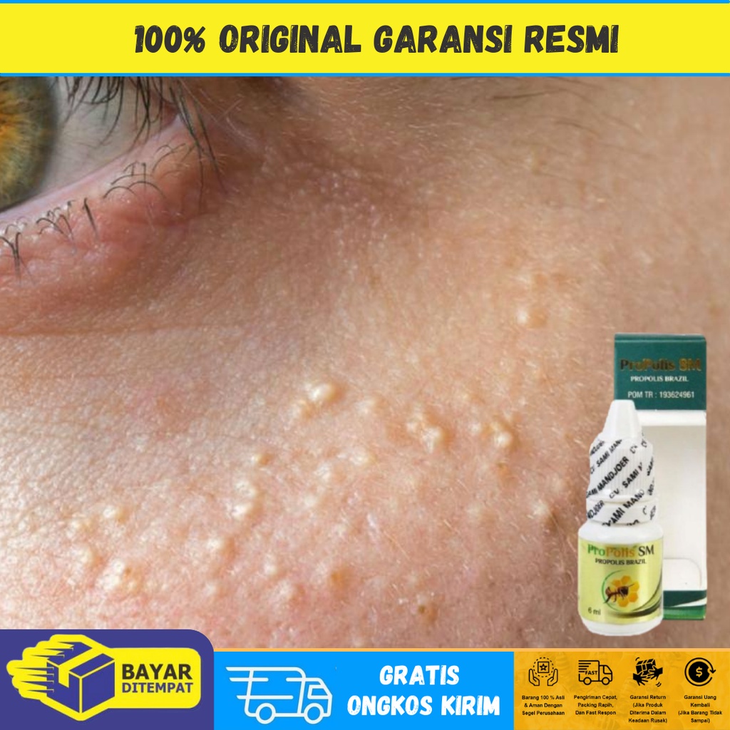 Obat Milia di Bawah Mata, Obat Penghilang Milia di area Mata, Obat Milia di Wajah, Obat Milia di Hid