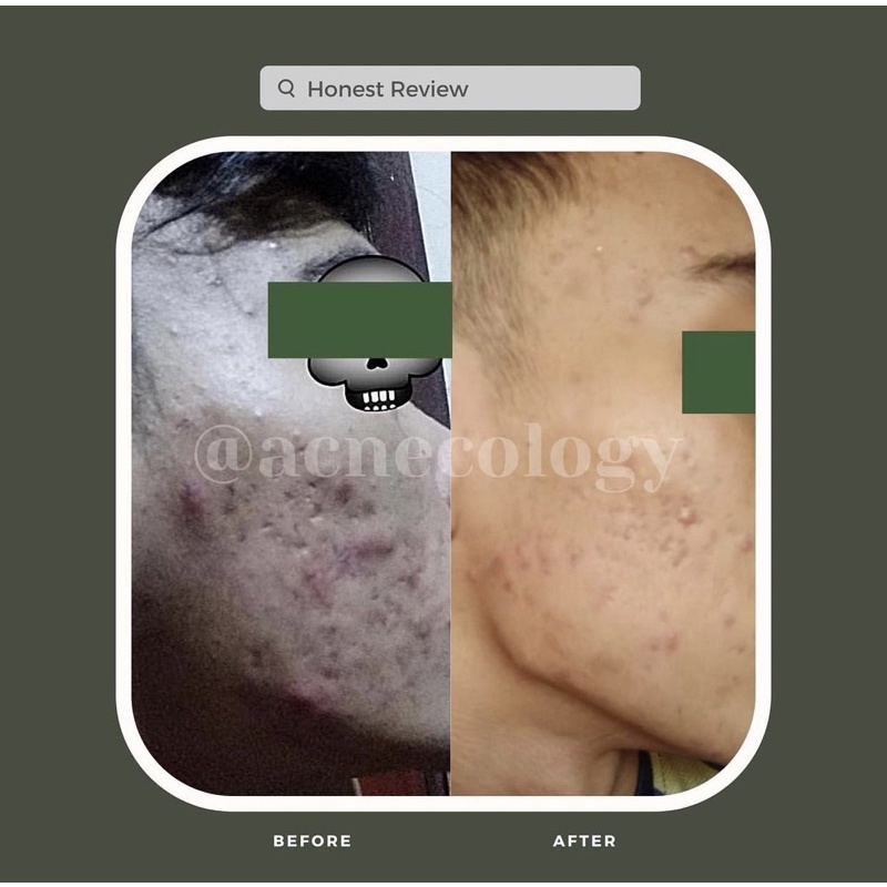 1 paket rangkaian anti scars (menghilangkan bopeng)