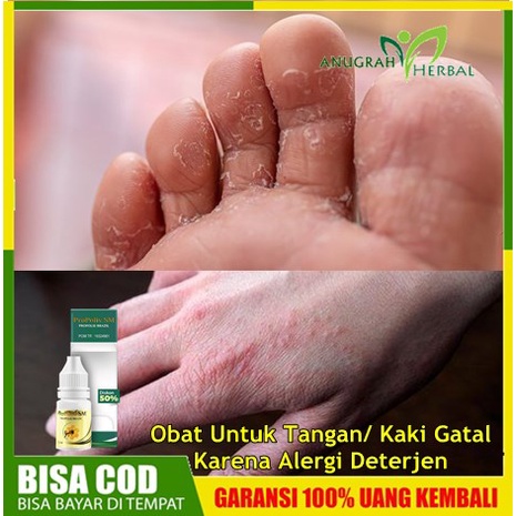 Obat Untuk Tangan/ Kaki Gatal Karena Alergi Deterjen - Herbal Penghilang Gatal Gatel Berair di Jari 