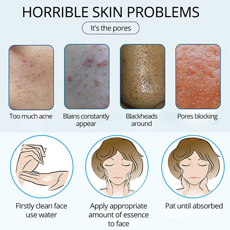 Beacuir Serum Penghilang Bekas Luka Flek Hitam Jerawat Dan Keloid Ampuh