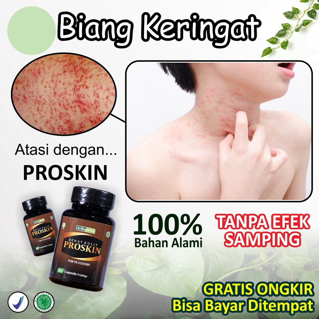 Obat Gatal Gatel Kulit Biang Keringat Bruntusan Suplemen Kesehatan Mengatasi Gatal2 Beruntusan Palin