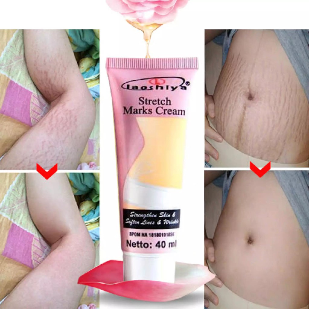 Laoshiya Stretch Mark Cream - Penghilang Strechmark Ampuh Permanen Bpom Stretchmark Stretch Mark Cream Krim Obat Salep