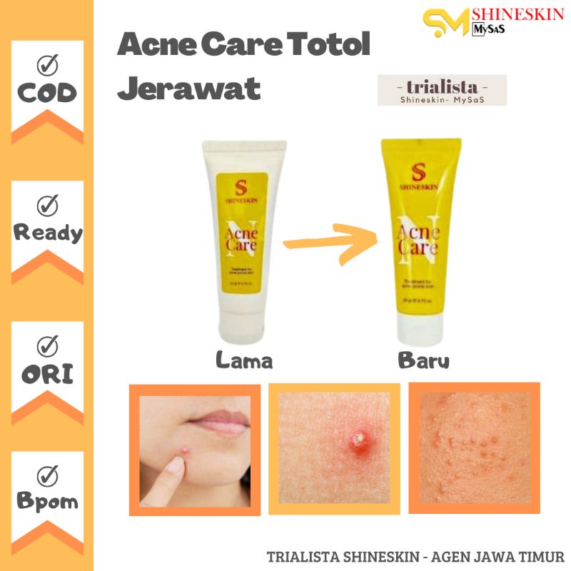 ACNE CARE SHINESKIN | OBAT TOTOL SHINESKIN | ACNE CARE N SHINESKIN