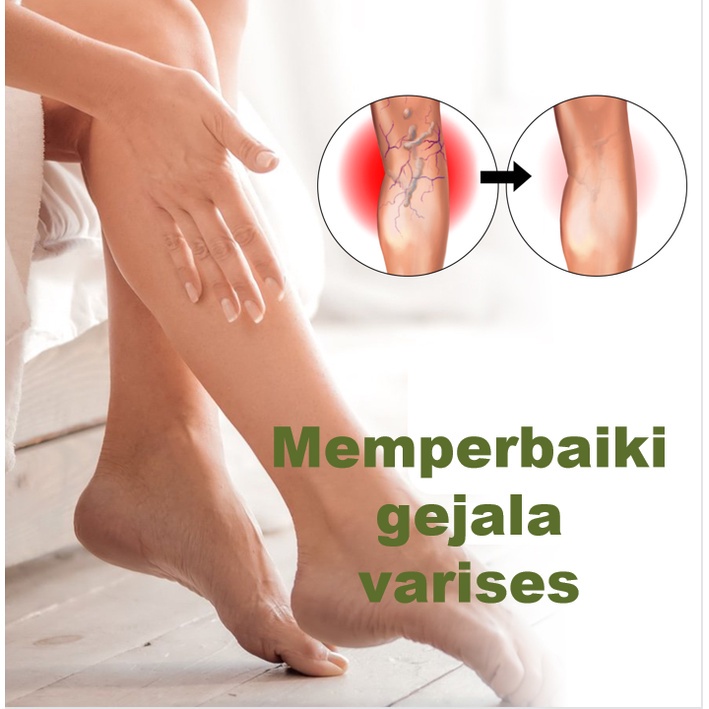 Varises salep penghilang bekas luka varises salep herbal 50g vaskulitis Menghilangkan rasa sakit, membuka sumbatan otot