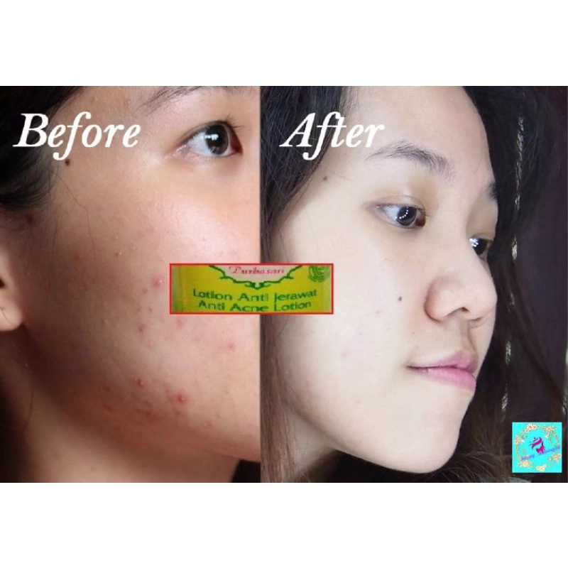 ♡Happyshoping88♡Purbasari Lotion Anti Jerawat - Obat Jerawat-6