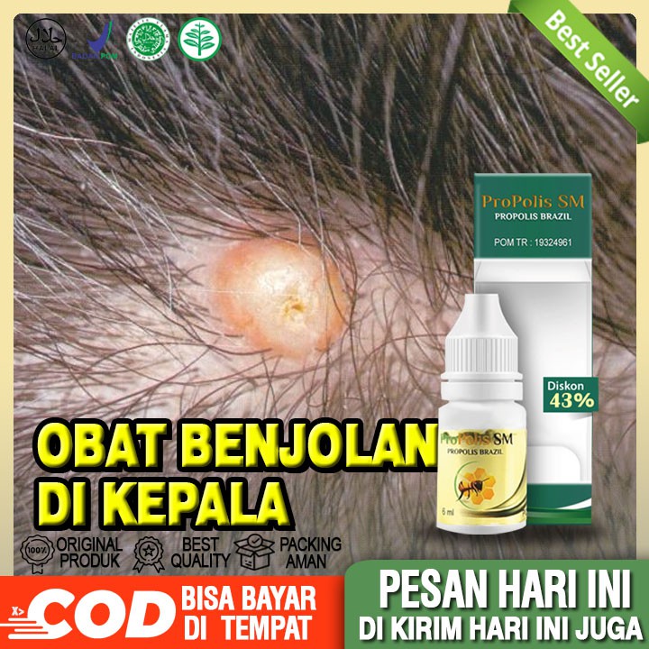 Obat Benjol Di Kepala, Kelenjar Getah Bening, Penghilang Lipoma, Penghilang Benjolan Di Kepala