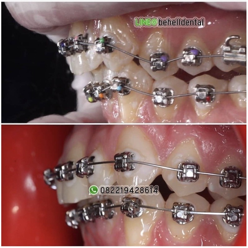 BRACKET BEHEL DAMON SISTEM METAL USA : SELF LIGATING . DAMOND SYSTEM ORIGINAL BEHELLDENTAL ORI