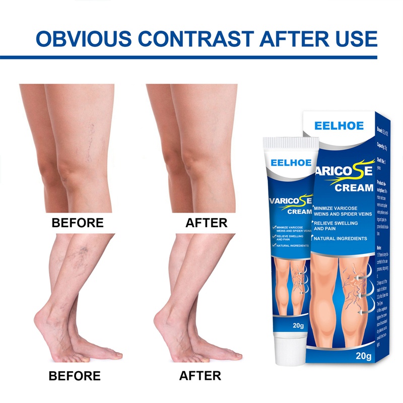 Salep Varises Cream Varicose Veins Obat Varises Kemaluan Bengkak Benjolan Buah Zakar Nyeri Testis Varicose Veins Cream 20Gr