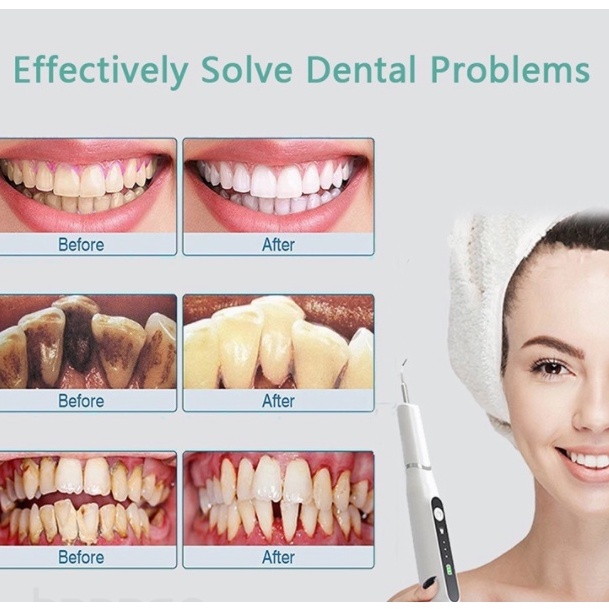 Dental Scaling Alat Pembersih Karang Gigi Sonic Elektrik 1 Set 3 Modes Perawatan