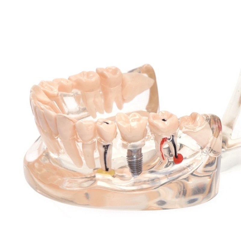 Dental Study Model Gigi Orthodontic Malocclusion PVC + Resin / Patung Gigi Phantom Bisa Di Lepas