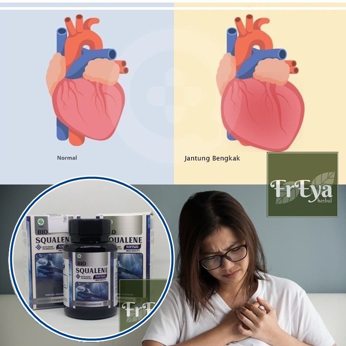 OBAT JANTUNG BENGKAK, OBAT HERBAL KARDIOMEGALI, OBAT PEMBESARAN JANTUNG, OBAT PEMBENGKAKAN JANTUNG (