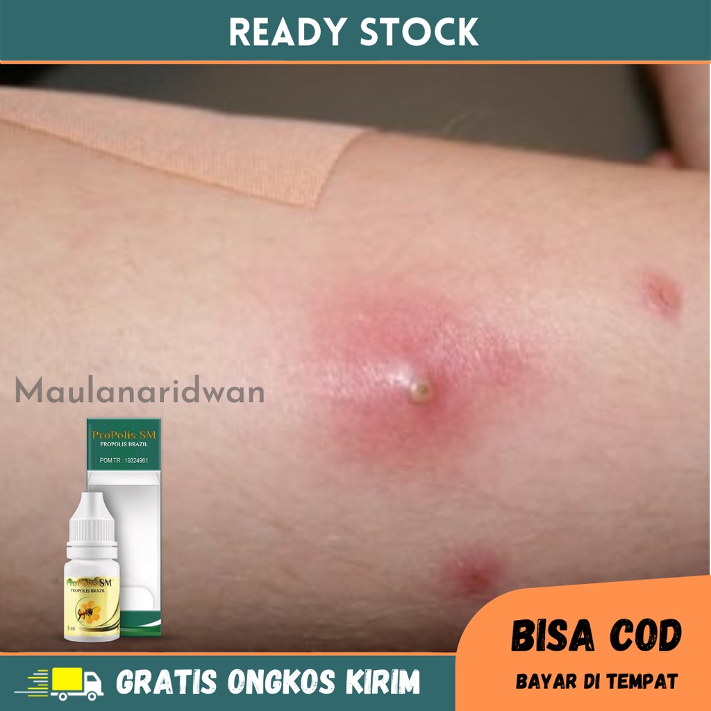 Obat Cenang Bernanah - Obat Benjolan Bernanah, Obat Koreng Bernanah, Obat Pengering Luka Nanah, Obat