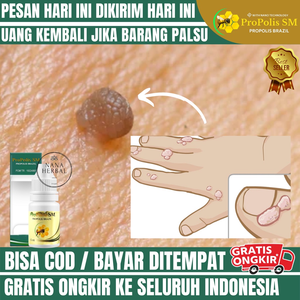 OBAT PAPILOMA / KUTIL, OBAT MENGHILANGKAN KUTIL, KUTIL DI KELOPAK MATA, DI WAJAH, DI BADAN, OBAT KUT