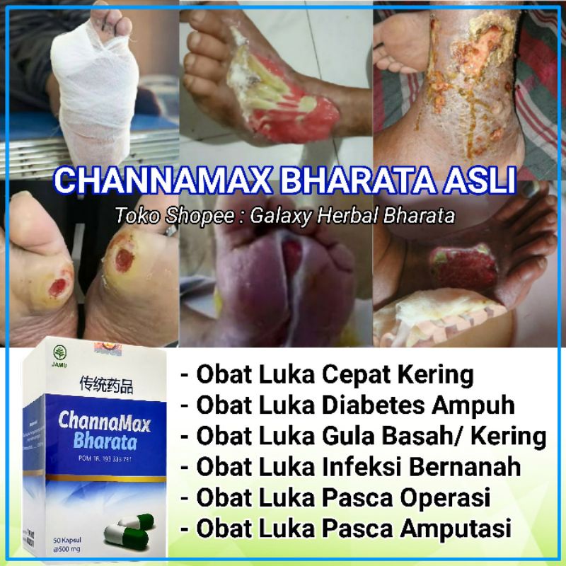Obat Luka Diabetes Cepat Kering Obat Luka Bernanah Channamax Bharata Original Isi 50 Kapsul Shopee Indonesia