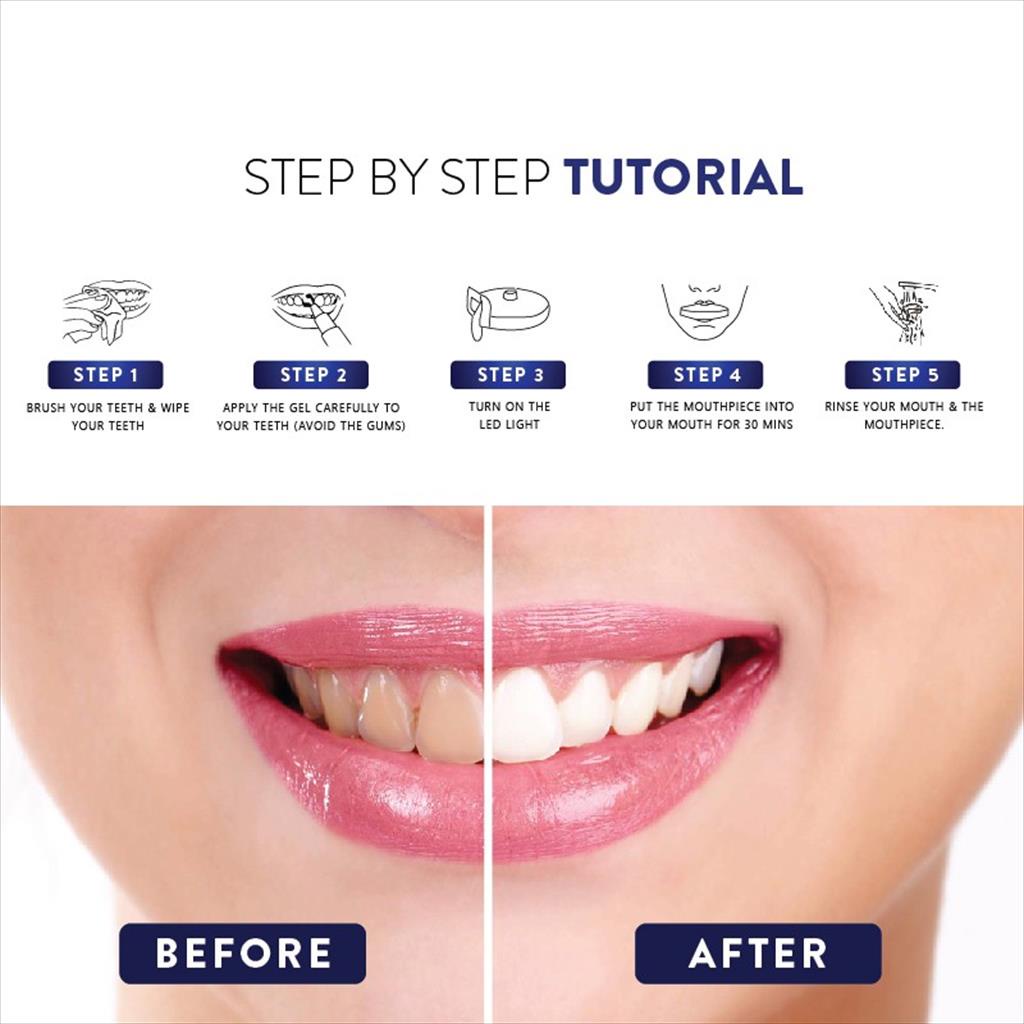 Beaudelab Deluxe Pemutih Gigi Permanen | Teeth Whitening Kit | Alat Pemutih Gigi Cepat Lampu LED [BEAUDELAB TEETH]